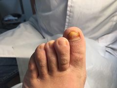 -世龙世家灰指甲鸡眼脚气甲沟炎跖疣护理(通州店)