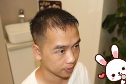 -大麦微针植发丨全国连锁