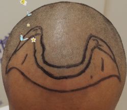 -大麦微针植发全国连锁