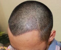 -大麦微针植发丨全国连锁