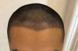 -大麦微针植发全国连锁