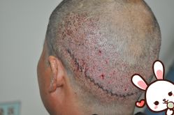 -大麦微针植发丨全国连锁