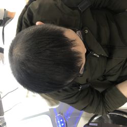 点击看大图 -大麦微针植发全国连锁