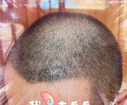 -大麦微针植发全国连锁