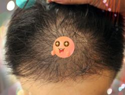 -大麦微针植发全国连锁