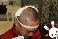 点击看大图 -大麦微针植发丨全国连锁