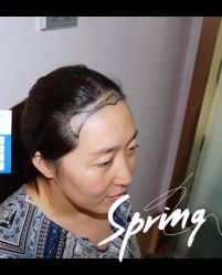 体验后-大麦微针植发全国连锁