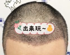 -大麦微针植发全国连锁