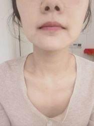 体验后-郑荃丽格医疗美容