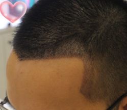 -大麦微针植发丨全国连锁