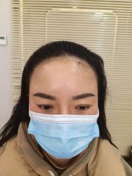 点击看大图 体验后-大麦微针植发丨全国连锁