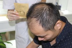 -大麦微针植发丨全国连锁