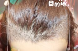 -大麦微针植发全国连锁