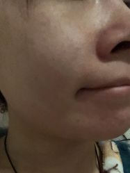 体验前-南宁维密整形·王敦华眼鼻整复中心