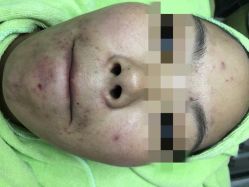 -苗医生草本科技祛痘