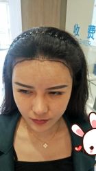 -大麦微针植发丨全国连锁