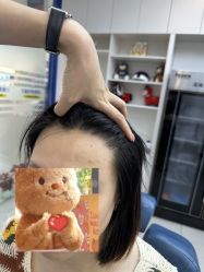 -大麦微针植发全国连锁