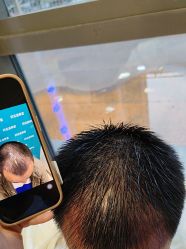 -碧莲盛·不剃发植发