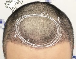 -大麦微针植发全国连锁