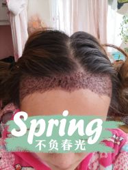 点击看大图 -大麦微针植发丨全国连锁