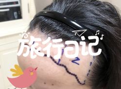 -大麦微针植发全国连锁