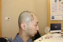 -大麦微针植发丨全国连锁