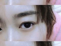 -黑马眼科·近视手术