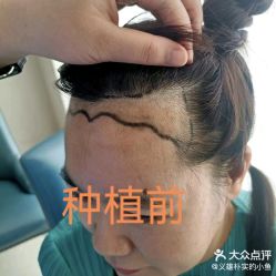 -大麦微针植发丨全国连锁