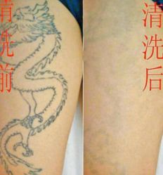 -新肤洗纹身