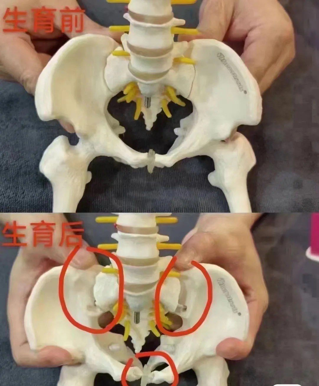 骨缝张开,体型变宽,臀部下垂,腹直肌分离,有腰酸痛情况,有脱垂,有打