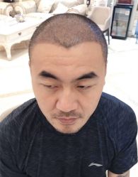 -大麦微针植发全国连锁