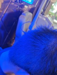 -碧莲盛·不剃发植发