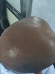 点击看大图 -碧莲盛·不剃发植发