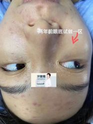 -爱莎扁平疣·汗管瘤·斑痣中心