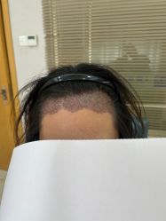 -大麦微针植发丨全国连锁