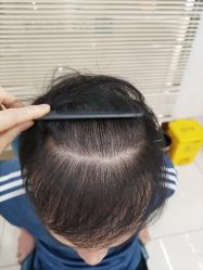 -大麦微针植发丨全国连锁