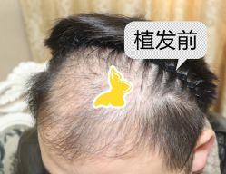 -大麦微针植发全国连锁