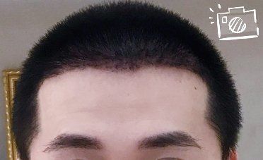 -大麦微针植发丨全国连锁