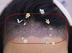 -大麦微针植发全国连锁