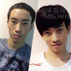 男士补发效果-髻尚坊增发补发织发假发定制