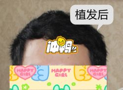 -大麦微针植发全国连锁