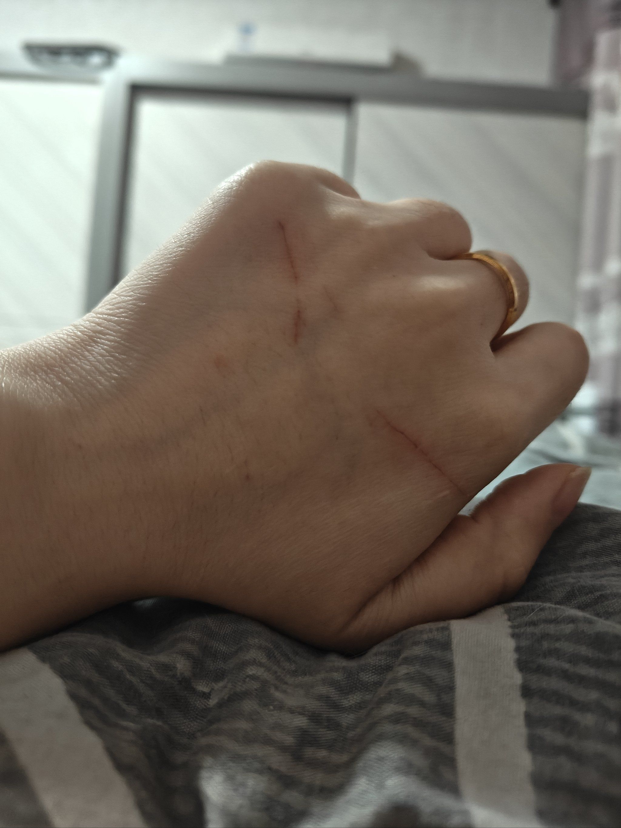 手被小猫抓伤了,难过