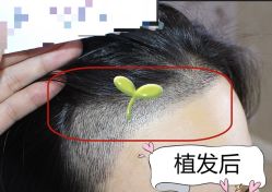 -大麦微针植发全国连锁