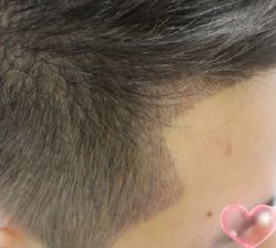 -大麦微针植发丨全国连锁