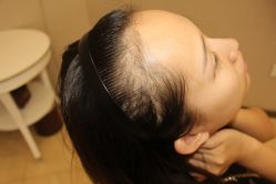 -大麦微针植发丨全国连锁