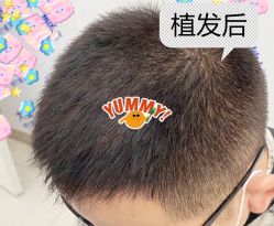 -大麦微针植发全国连锁