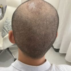 点击看大图 -大麦微针植发全国连锁