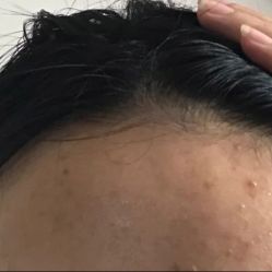 -成都苗方清颜专业祛痘