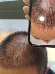 -碧莲盛·不剃发植发