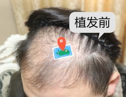 -大麦微针植发全国连锁